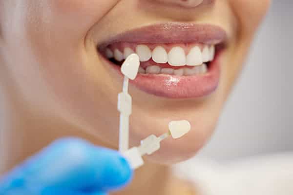 Smiling woman with dental color guide