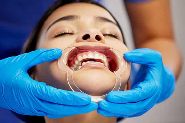 Hands holding dental aligner tray