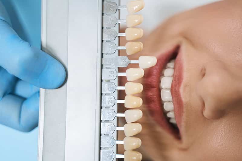 Comparing dental veneers shade options.